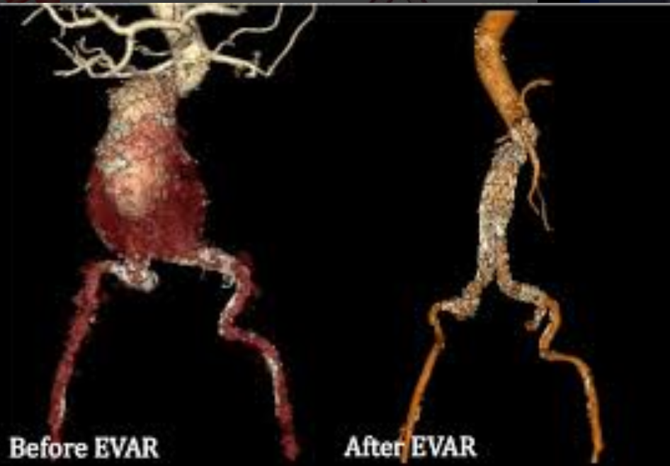EVAR 07