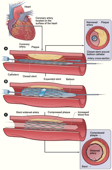 PTCA stent NIH