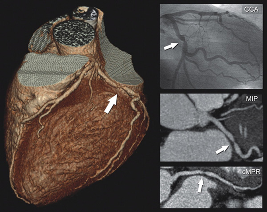 coronary CT angiography