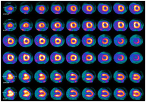 اسکن هسته ای قلب